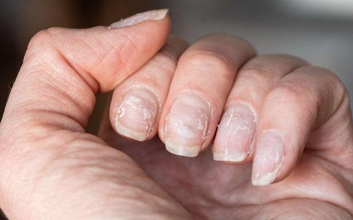 آیا لایه لایه شدن ناخن نشانه یک بیماری است؟