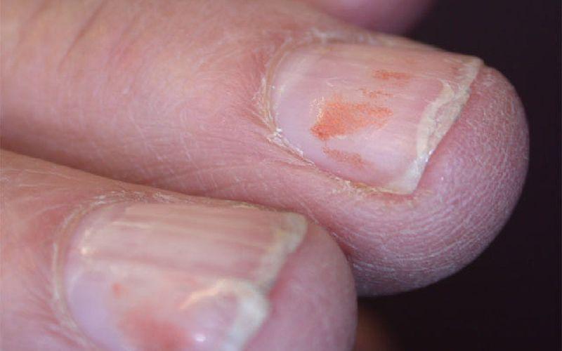 آیا لایه لایه شدن ناخن نشانه یک بیماری است؟