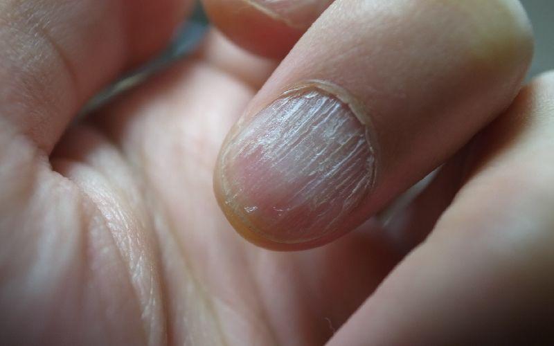 آیا لایه لایه شدن ناخن نشانه یک بیماری است؟