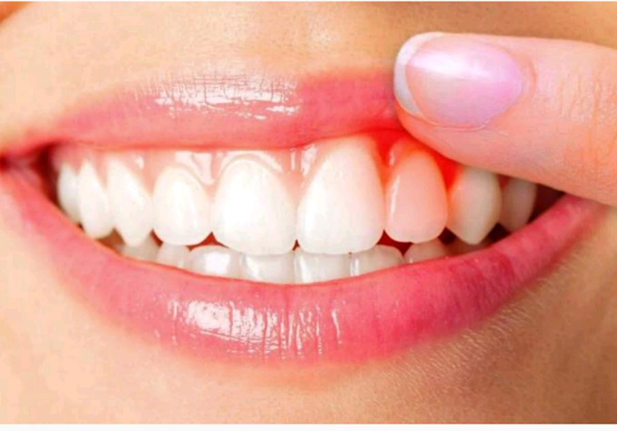 التهاب لثه چگونه مغز را تحت تاثیر قرار میدهد؟