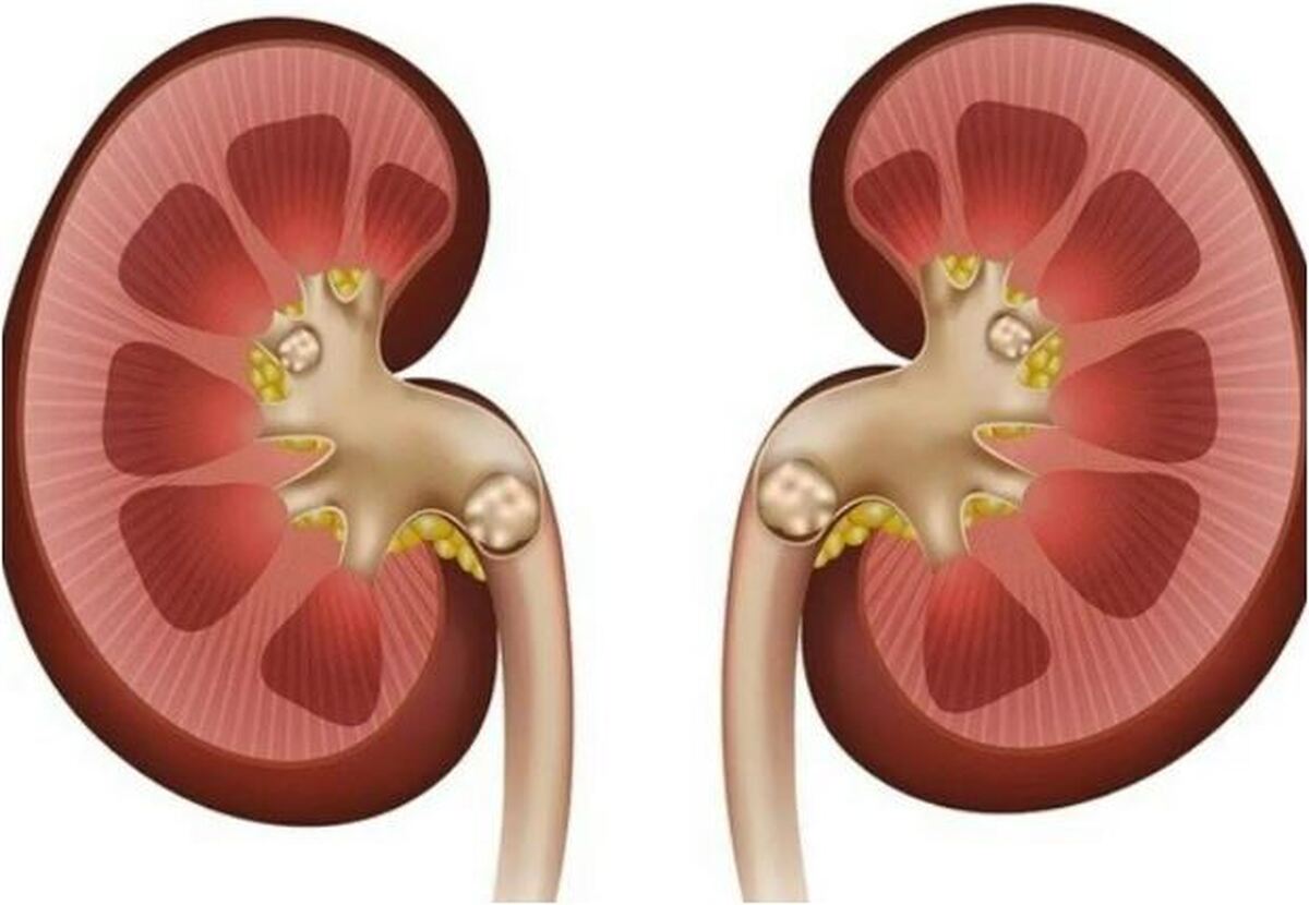 راه‌های جلوگیری از به وجود آمدن سنگ کلیه