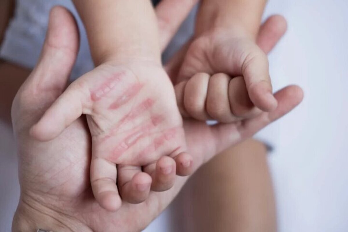 در مواجهه با بیمار سوختگی چه باید کرد؟
