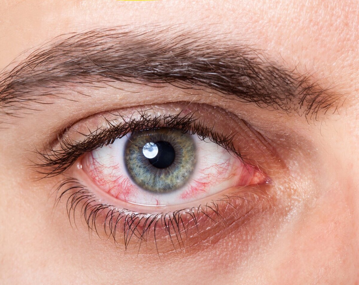 چگونه زخم عفونی قرنیه را تشخیص دهیم؟