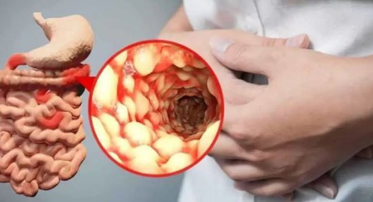 ریسک ابتلا به سرطان با شیوع بیماری‌های التهابی روده!