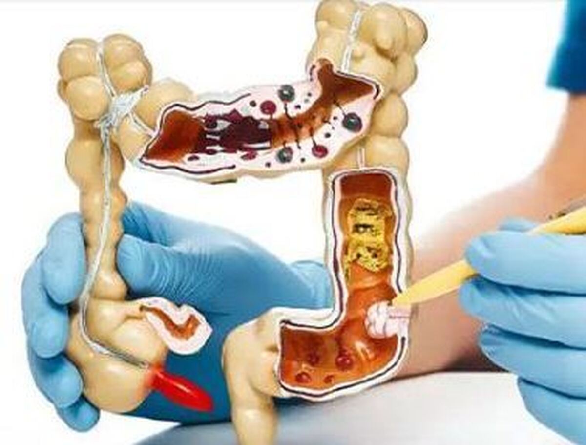 کدام سرطان‌ها به تغذیه مرتبطند؟