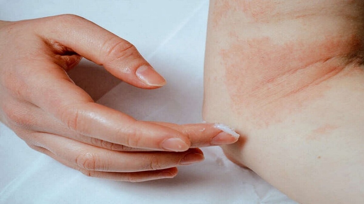 علل اصلی آلرژی به سرما