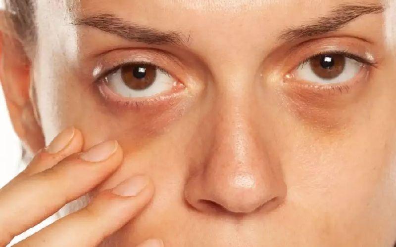 علل ریشه‌ای که باعث سیاه شدن زیر چشم می‌شود/از کم خوابی تا آلرژی