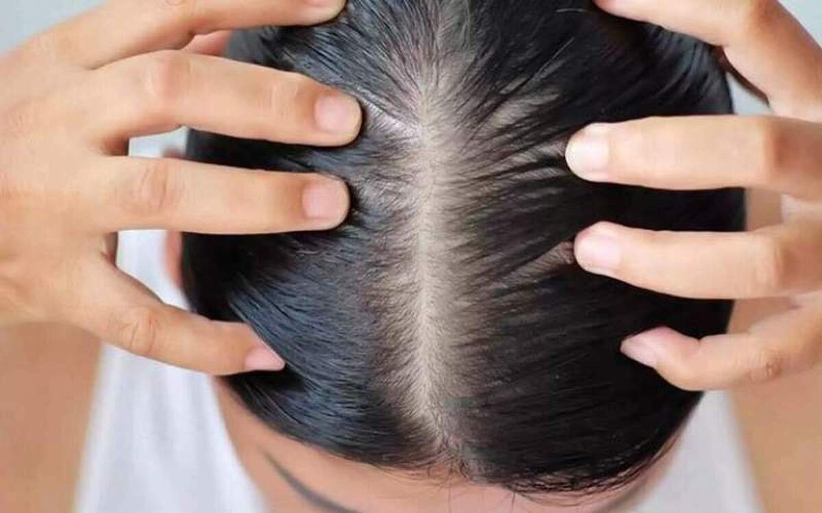 چند توصیه تغذیه‌ای برای جلوگیری از ریزش مو