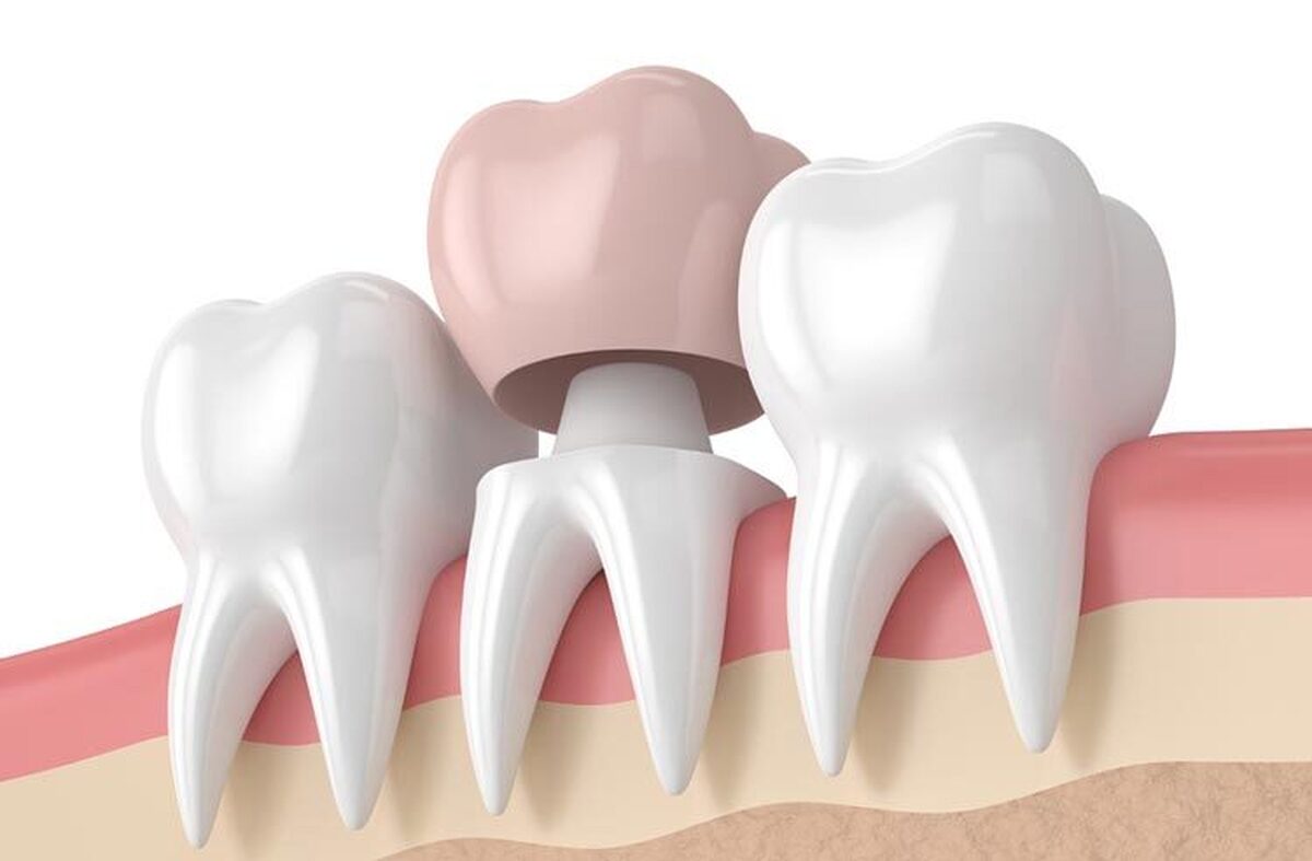 روکش کردن دندان چه مزایایی دارد؟