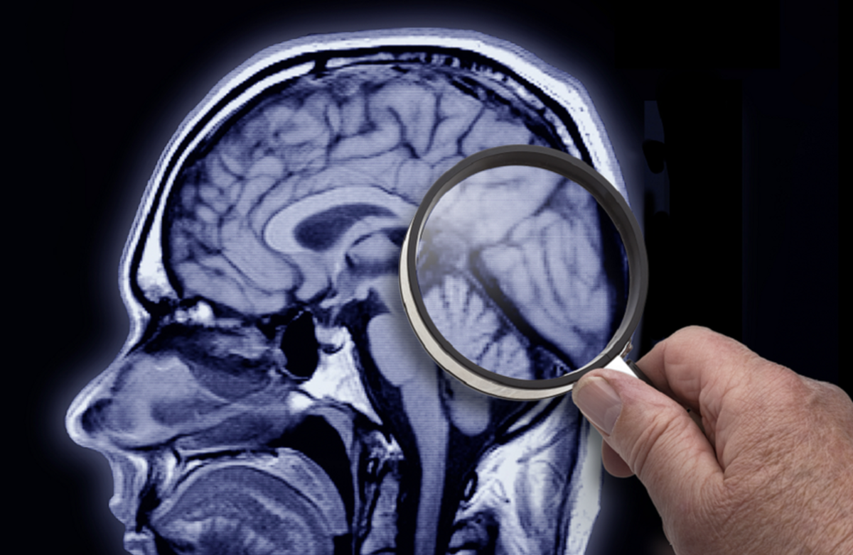 آزمایش جدید آلزایمر را قبل از ظهور علائم پیش بینی می‌کند