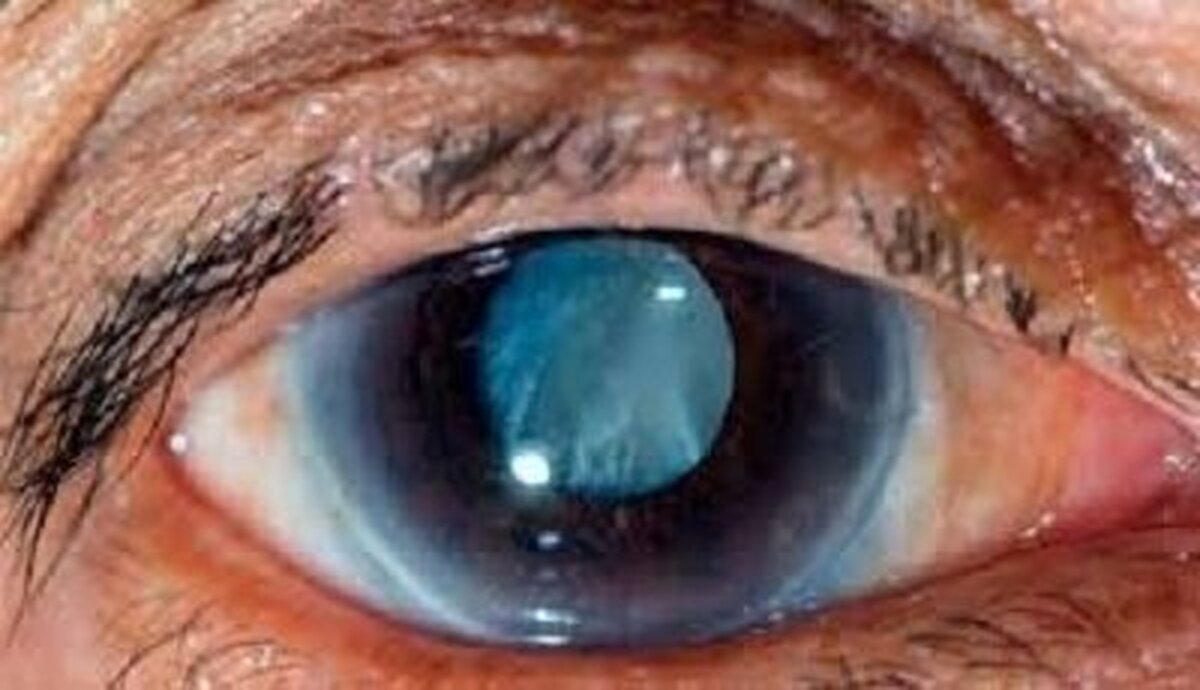 برای پیشگیری از آب سیاه چشم معاینات منظم بهترین راه است!