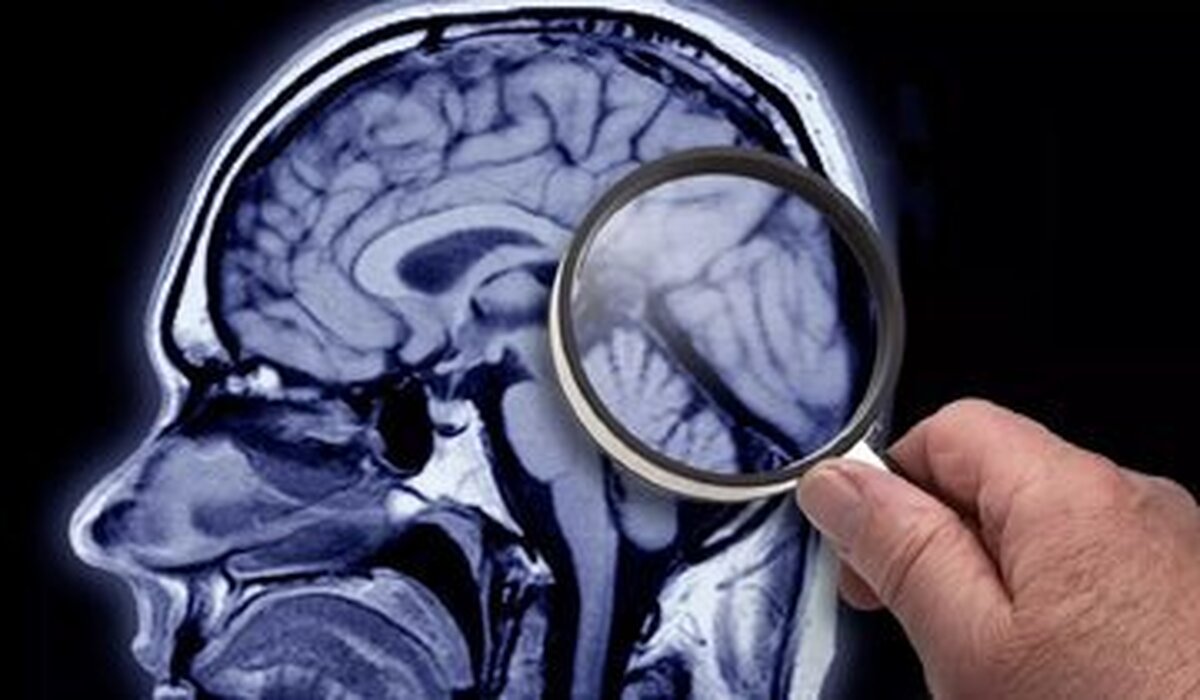 علائم زوال عقل و ارتبط آن با عادات غذایی