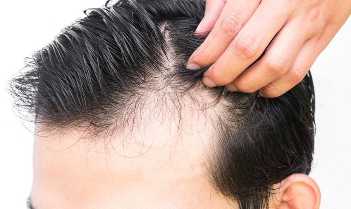بررسی انواع علت‌های ریزش مو