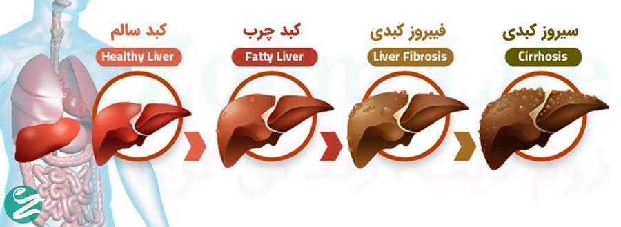 کبد چرب چند گرید دارد و علائم هر کدام چیست؟