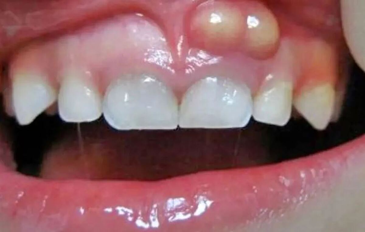 بیماری لثه چگونه منجر به آلزایمر میشود؟