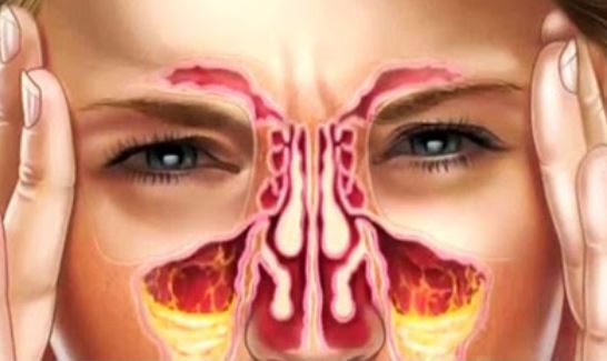 مخاط سیاه بینی نشانه چه بیماری است؟