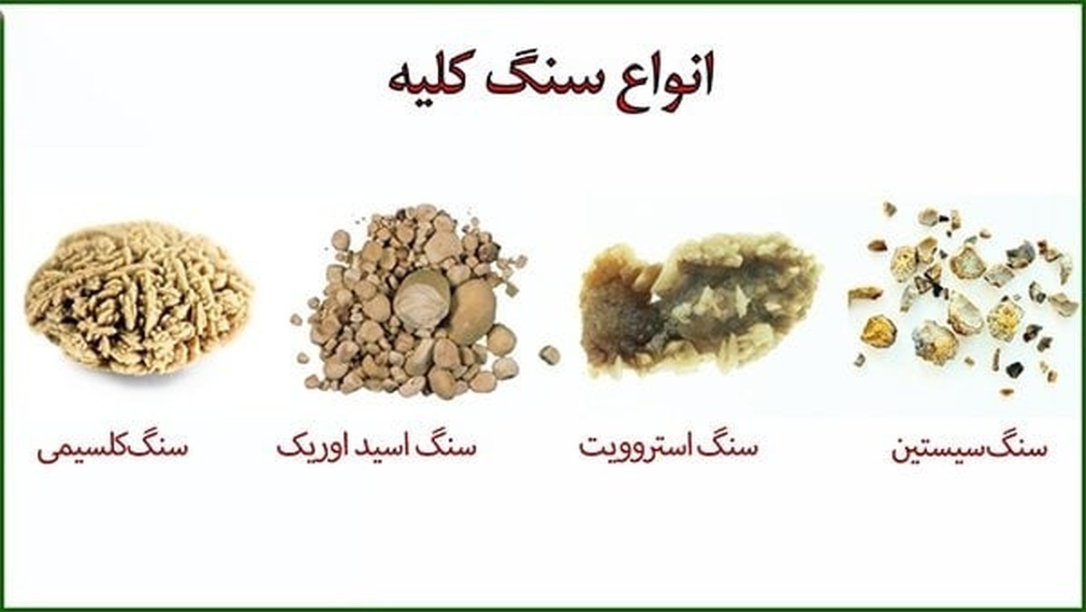 دفع سنگ کلیه با یک فرآورده طبیعی مکمل ایرانی!