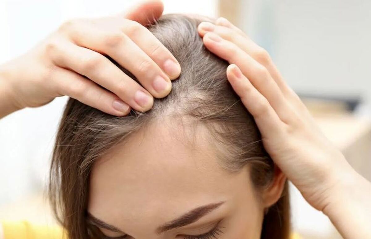 ۷ درمان طبیعی و کم هزینه برای ریزش مو