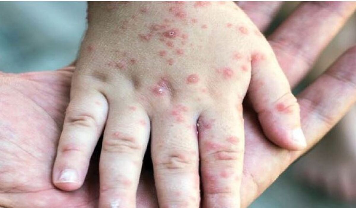 شیوع بیماری پوستی سرخک در یک دانشگاه علوم پزشکی مورد بررسی قرار گرفت