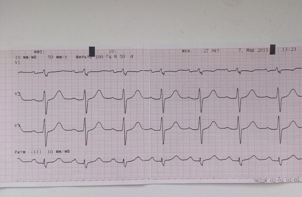 روسیه| توسعه یک برنامه کامپیوتری برای تجزیه و تحلیل ECG