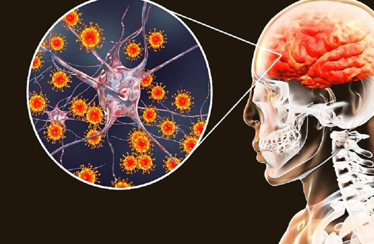 اشتباه گرفتن آبله مرغان با مننژیت! علائم و تشخیص