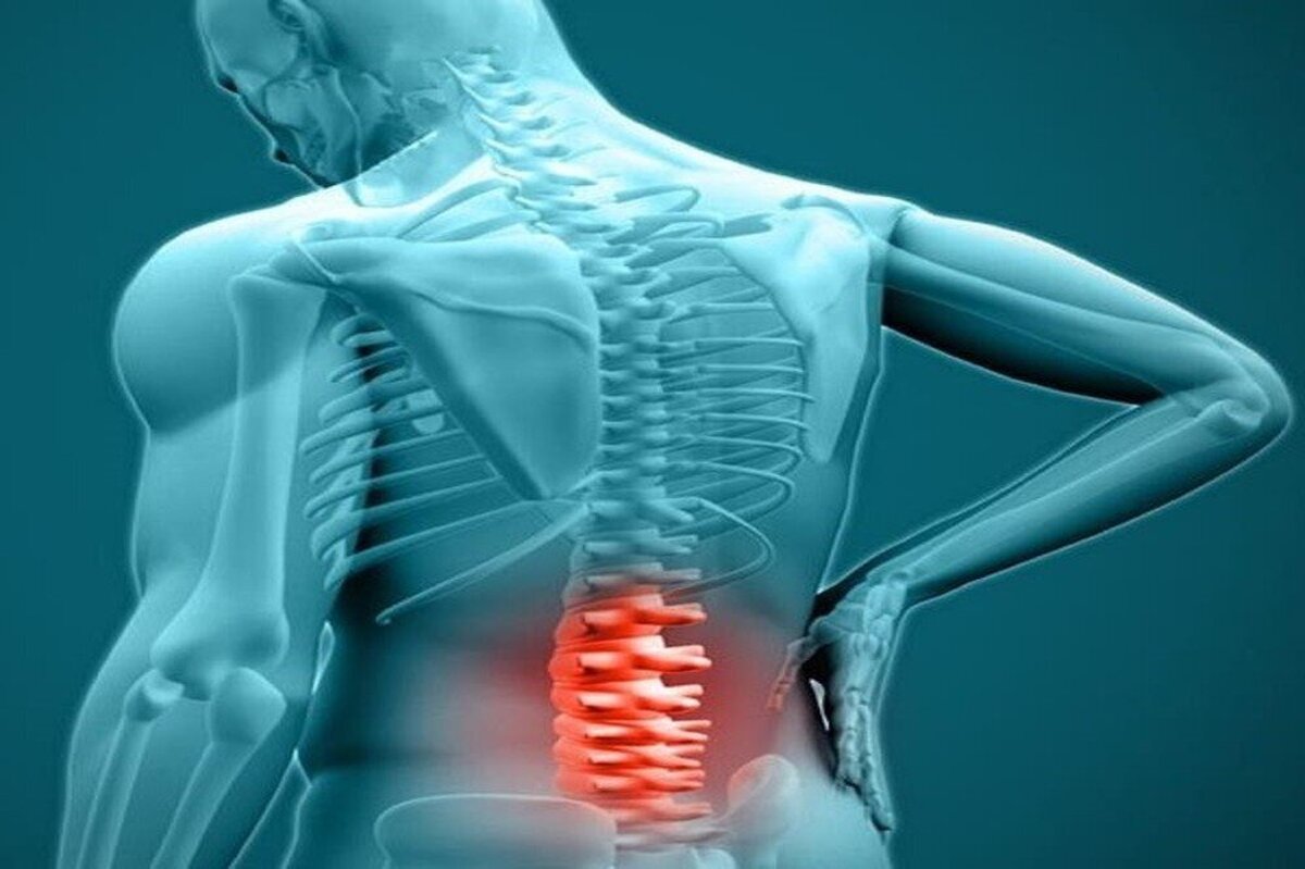 چگونه به دیسک کمر مبتلا میشویم؟
