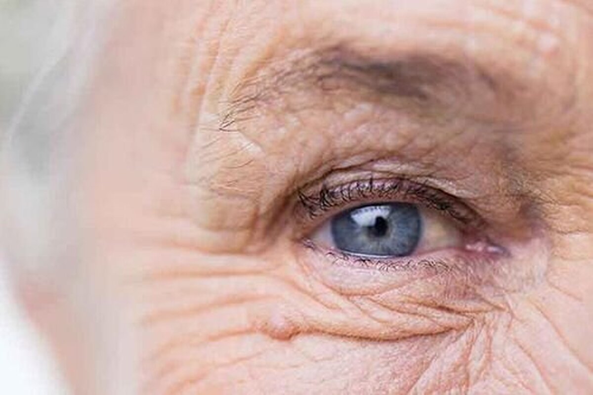 ارائه راهکار‌های تشخیص زودهنگام بیماری قوزقرنیه بر پایه یادگیری ماشین
