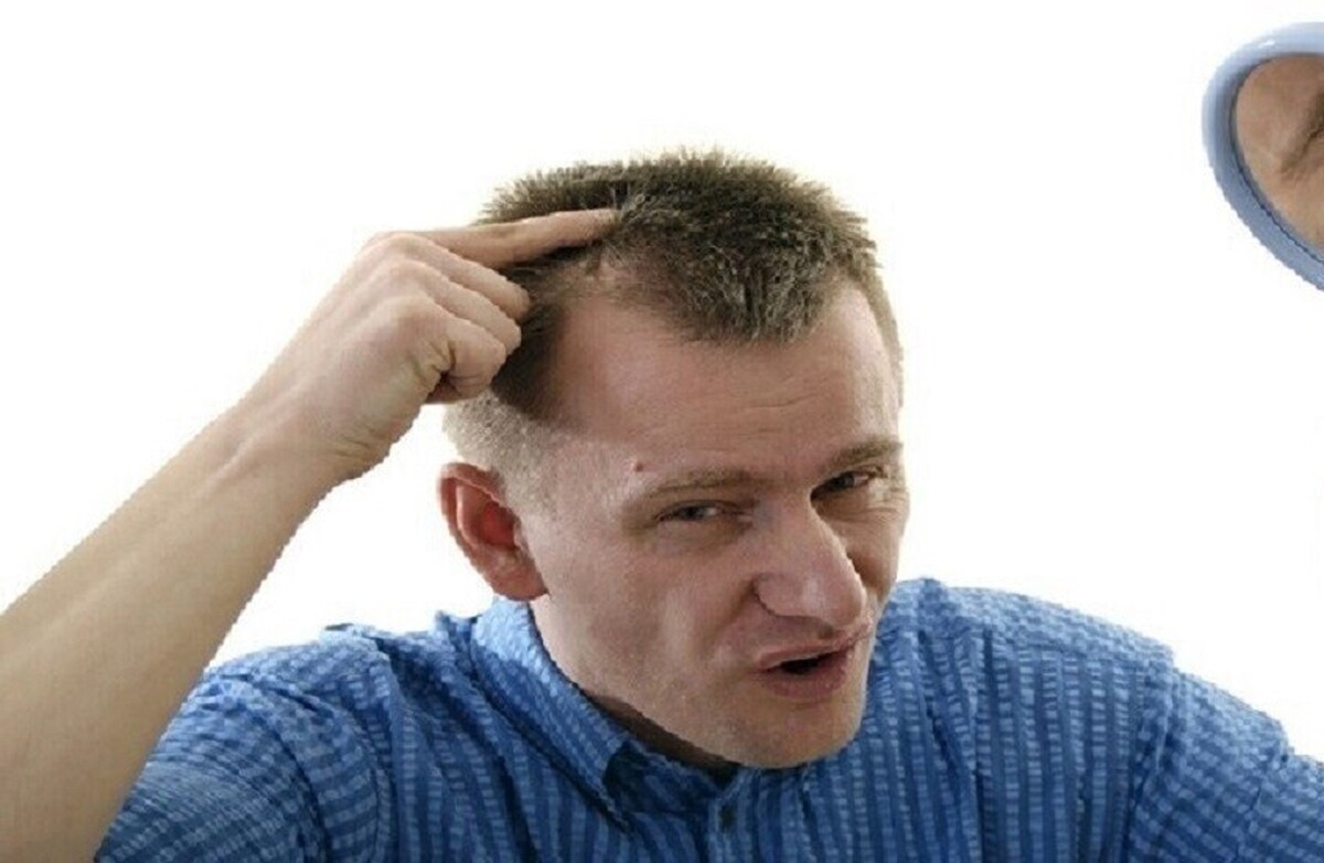 پزشک: استرس عاطفی شدید باعث طاسی می‌شود