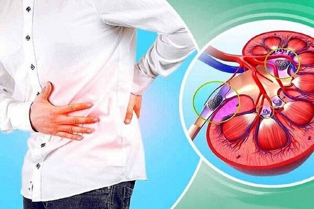 روش‌های تشخیص سنگ کلیه + درمان آن!