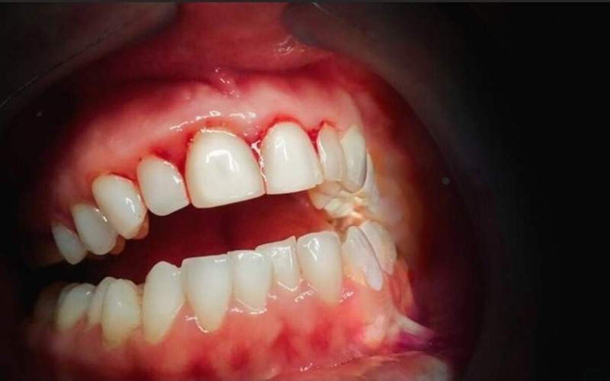 بررسی دلایل شایع خونریزی از لثه