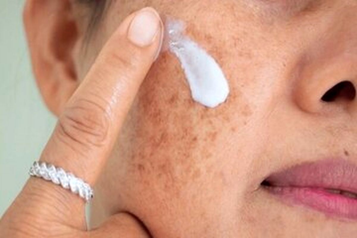 لکه‌های پوستی در دوران بارداری چه علتی دارد؟