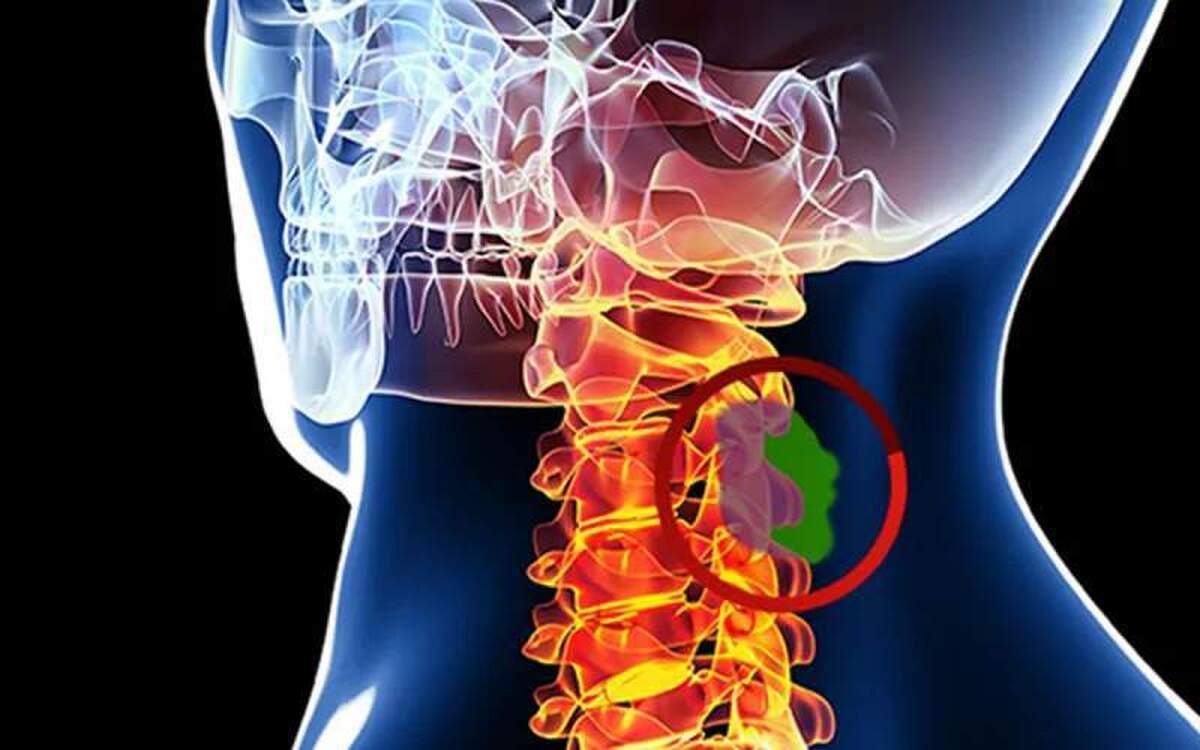 علائم شایع تومور طناب نخاعی