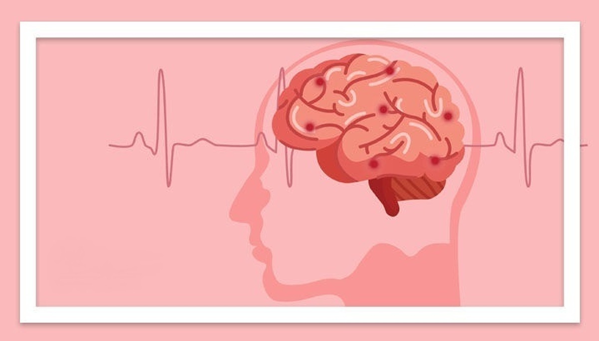 چگونه شانس بهبودی سکته مغزی را افزایش دهیم؟