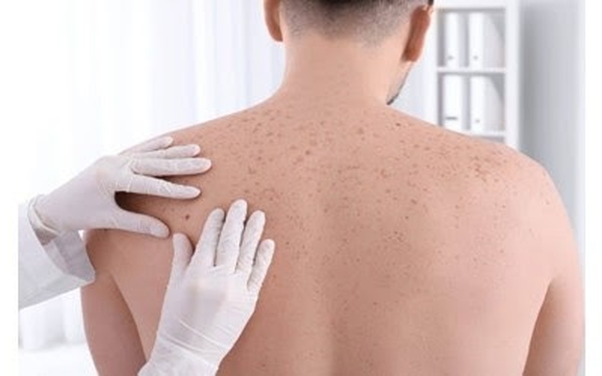 هشدار درباره احتمال تبدیل شدن آکنه معمولی به سرطان!