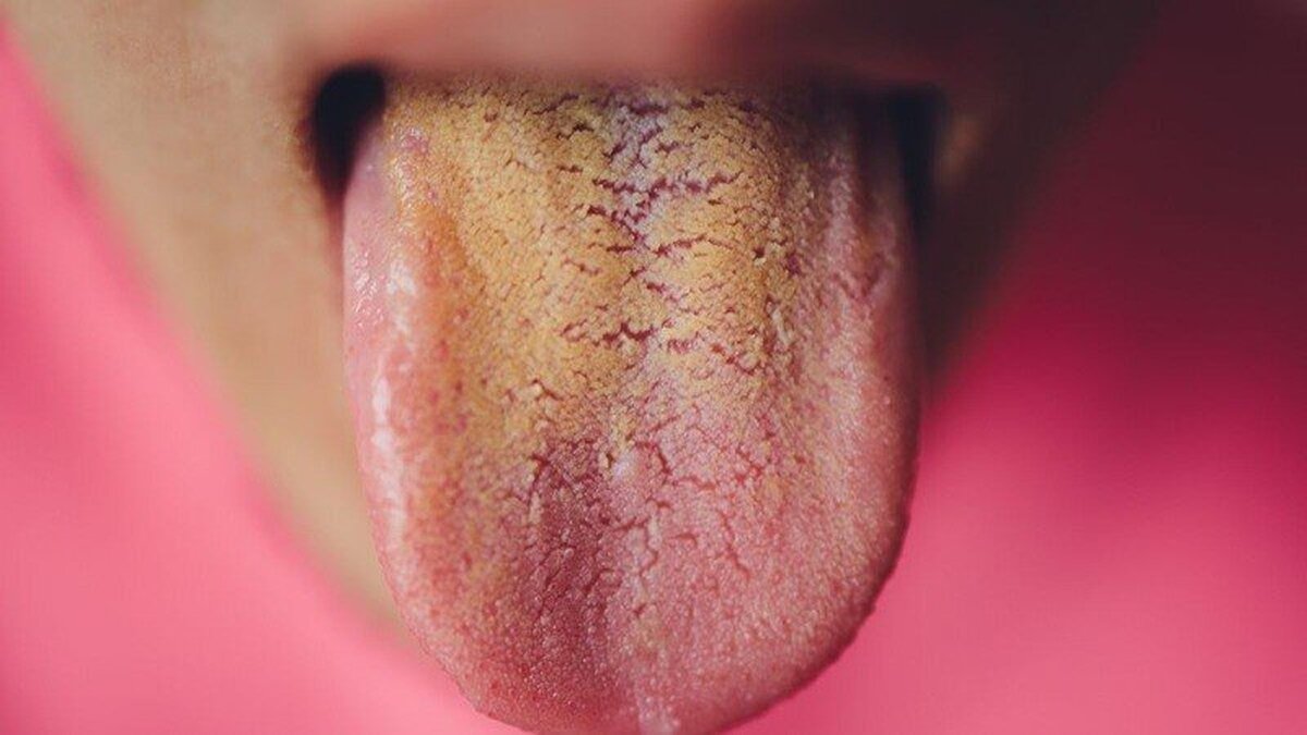 تغییر رنگ زبان درمورد سلامت شما چه می‌گوید؟/ آیا راهی برای رفع زردی زبان هست؟