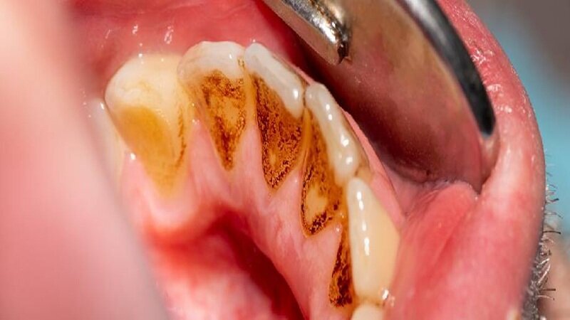 تغییر رنگ زبان درمورد سلامت شما چه می‌گوید؟/ آیا راهی برای رفع زردی زبان هست؟