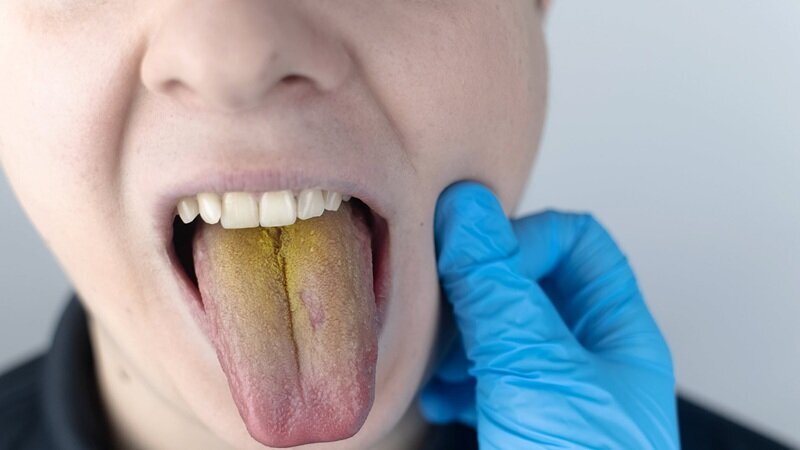 تغییر رنگ زبان درمورد سلامت شما چه می‌گوید؟/ آیا راهی برای رفع زردی زبان هست؟