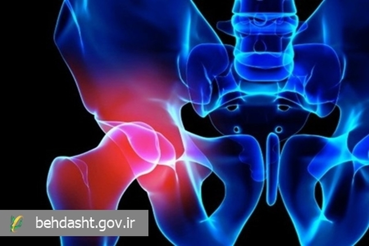 چگونه از ابتلا به آرتروز مفصل لگن پیشگیری کنیم؟