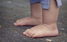 داشتن کف پای صاف ربطی به مشکلات ماهیچه‌ای - استخوانی ندارد!