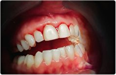 مواظب دندان‌تان باشید تا سرطان نگیرید!