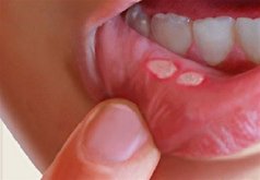عامل آفت دهانی کدام عضو بدن است؟