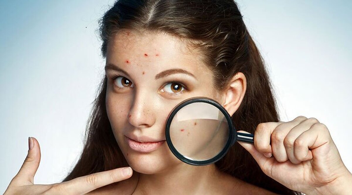 جای زخم و عفونت از جمله عوارض ترکاندن جوش صورت