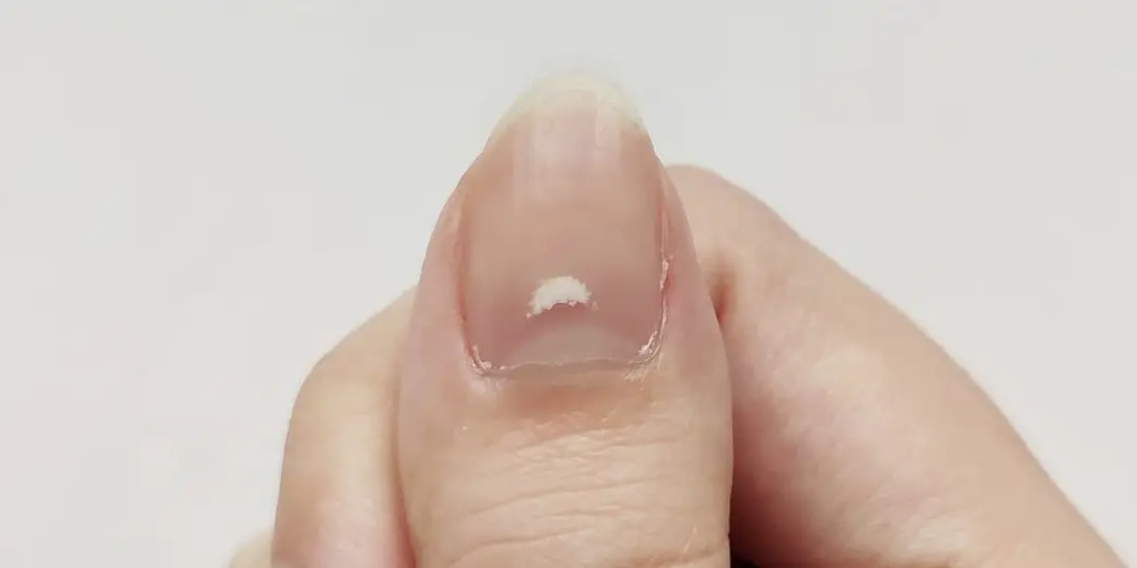 لکه‌های کوچک سفید روی ناخن نشانه بیماری است؟