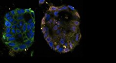 کشف مسیری جدید برای درمان سلول‌های سرطانی