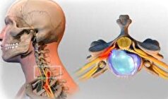 دلیل اصلی سندرم دیسک گردنی چیست؟