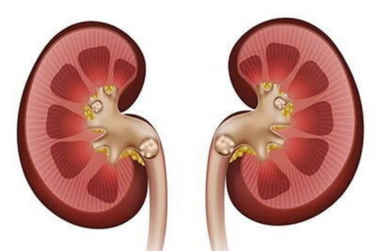 انجام چه کار‌هایی موجب ابتلا به سنگ کلیه میشود؟