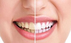 توصیه‌های تغذیه‌ای مناسب برای سفیدی دندان‌هایتان