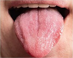 اگر این علائم روی زبانتان ظاهر شد، از نوشیدن قهوه اجتناب کنید