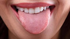 علل شایع خشکی دهان و روش‌های حل این مشکل چیست؟