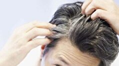 قطع ریزش مو و رویش مجدد با بیوتین / اگر به سلامت موهایتان اهمیت می‌دهید از ویتامین ۷ B غافل نشویید